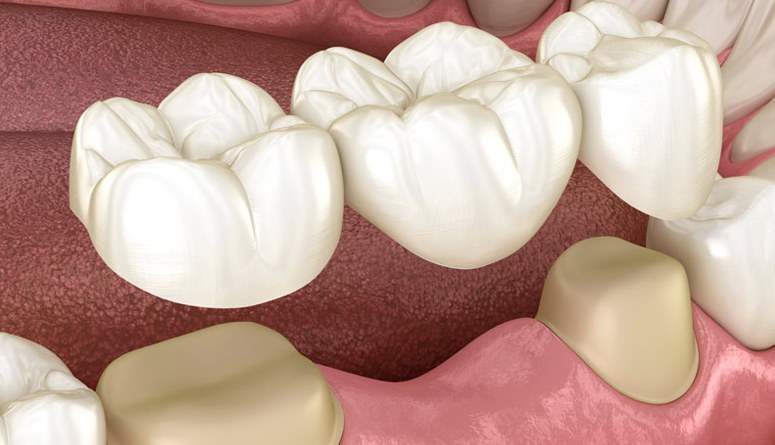 Dental crowns and bridges displayed on model gums showing restorative dentistry procedures.
