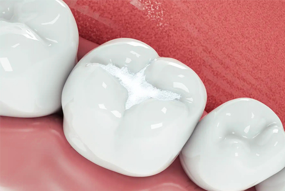 Three white dental crowns displayed on pink gum model surface for restorative dentistry demonstration.