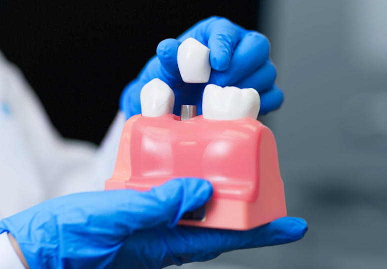 dental crowns woodbridge