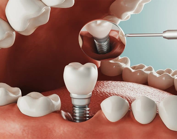Dental Implants in Woodbridge