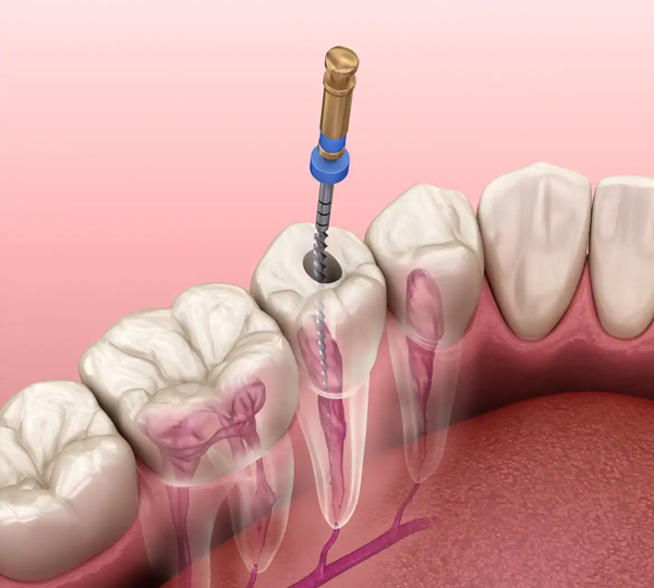 Root Canal Retreatment in Woodbridge