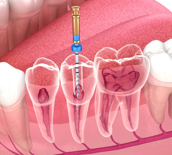 Dental illustration showing root canal procedure on tooth with injection needle and canal treatment visualization.