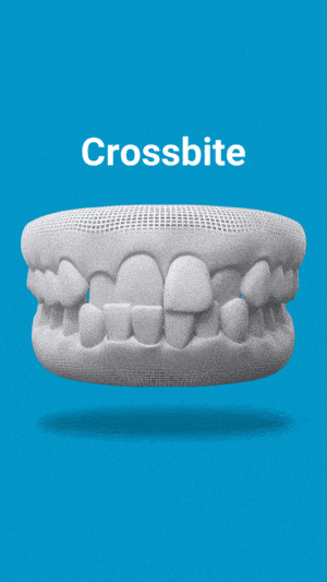 3D dental model showing crossbite malocclusion with misaligned upper and lower teeth on blue background.