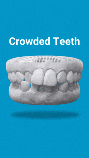 Dental model displaying crowded teeth condition on blue background with text label.