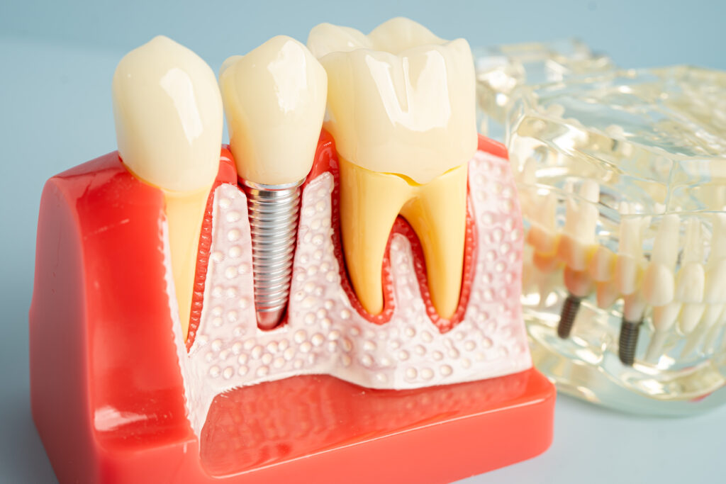 DENTAL IMPLANT