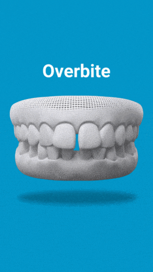 Dental model showing overbite condition with upper teeth protruding over lower teeth on blue background.